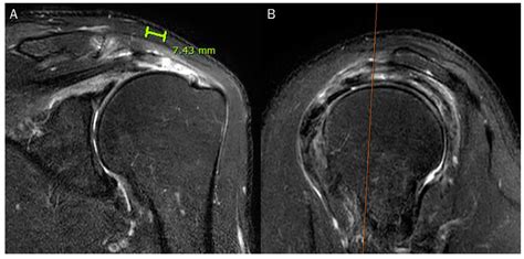 special tests for rotator cuff tear vs mri|rotator cuff tear mri pattern.